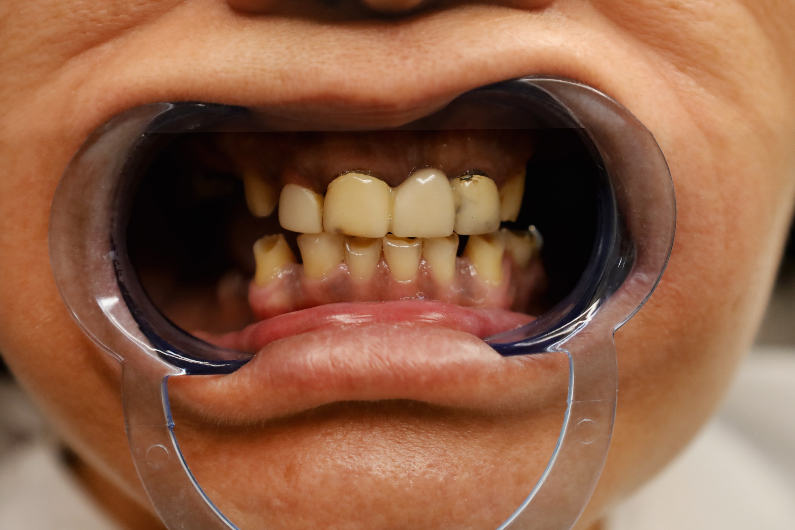 Corone zirconio — WestDent Clinic