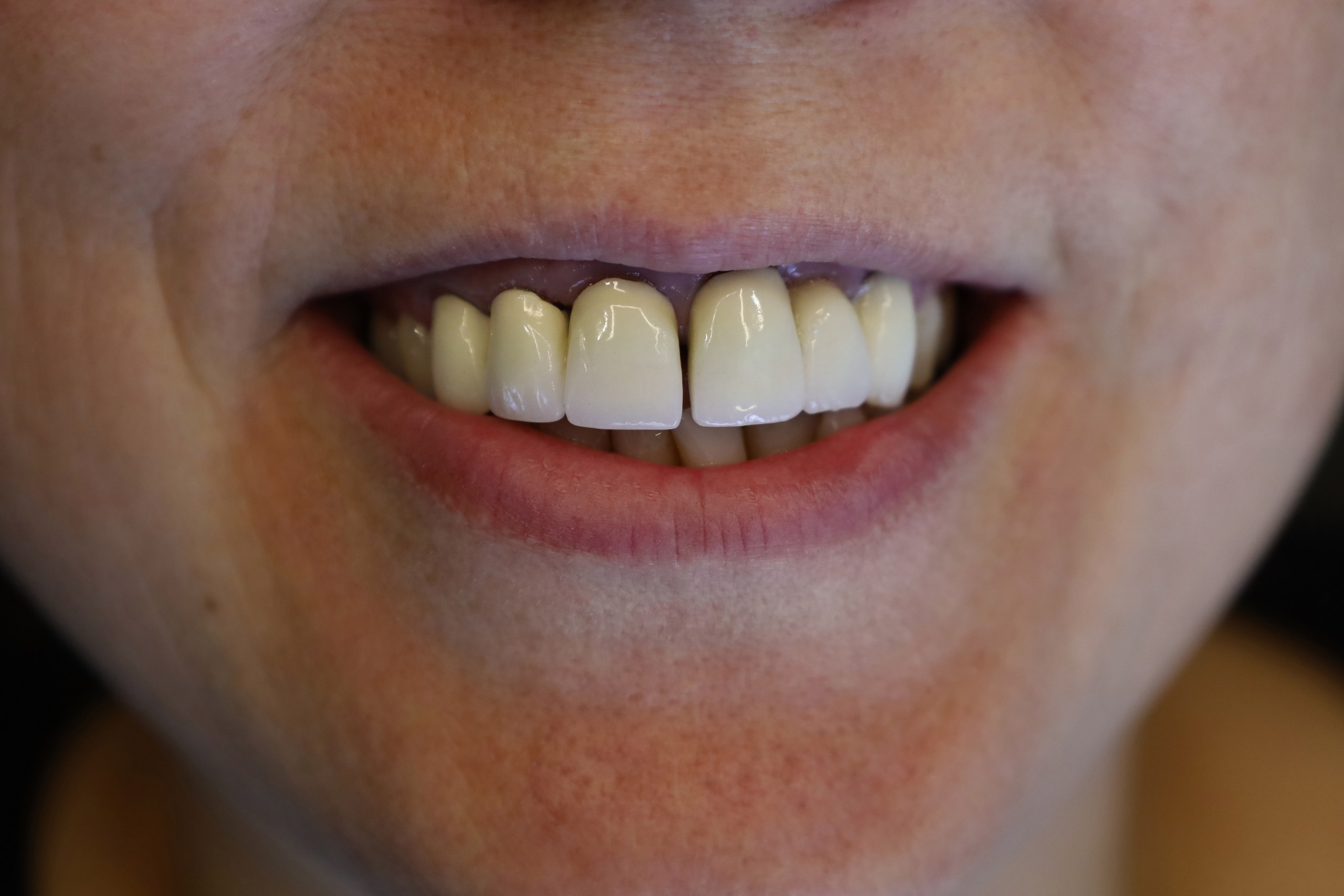 Corone zirconio — WestDent Clinic