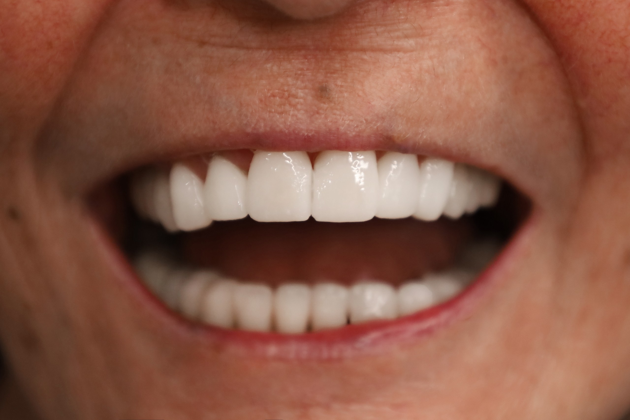 Corone zirconio — WestDent Clinic