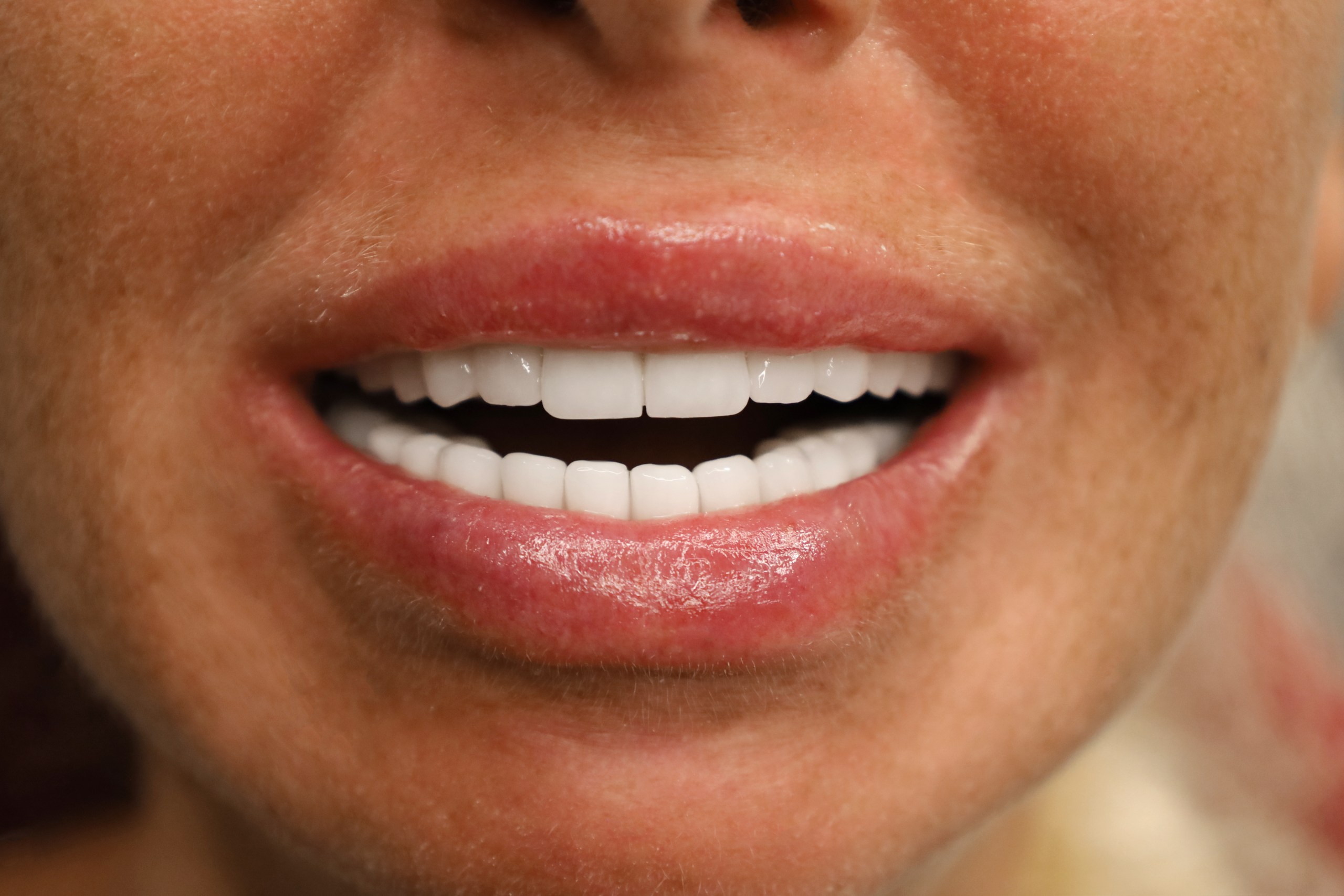 Corone zirconio — WestDent Clinic