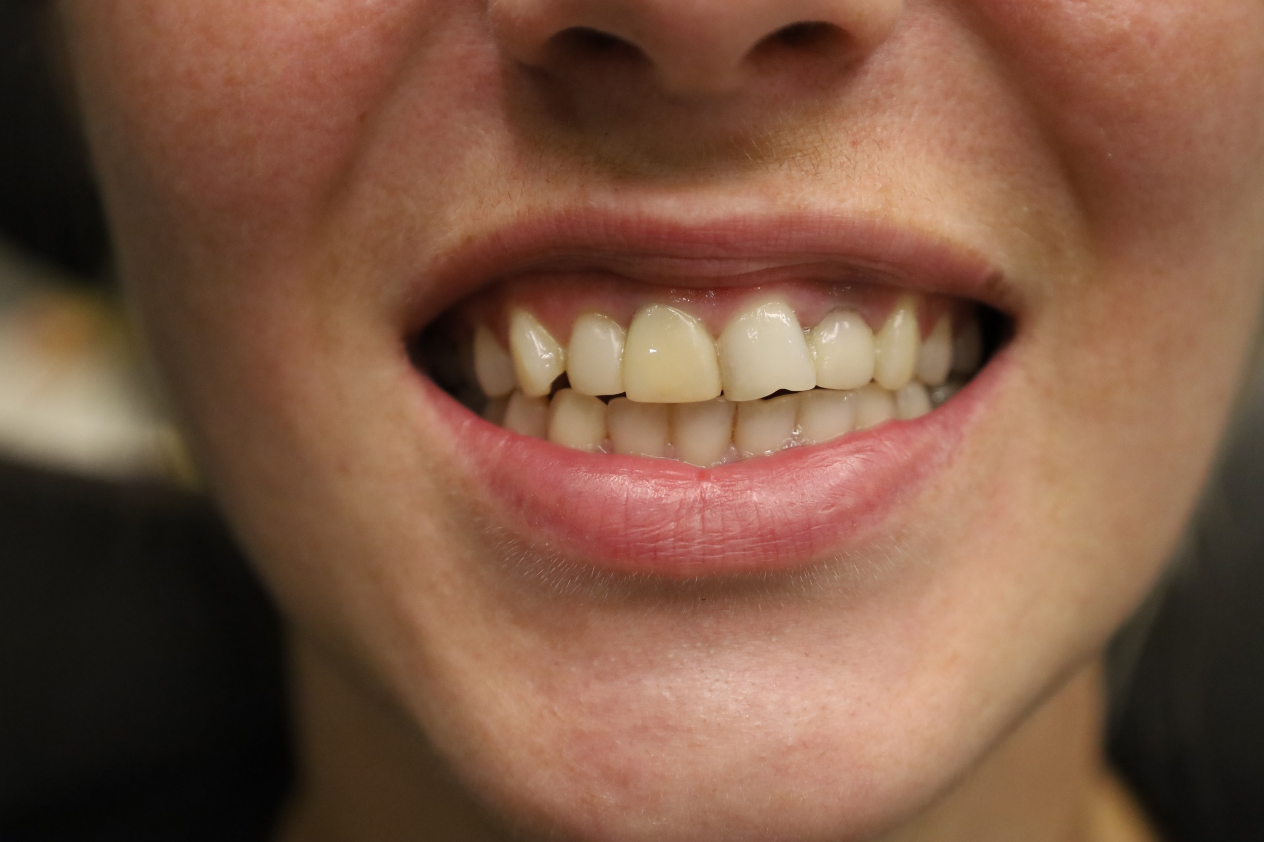 Facettes Emax — WestDent Clinic