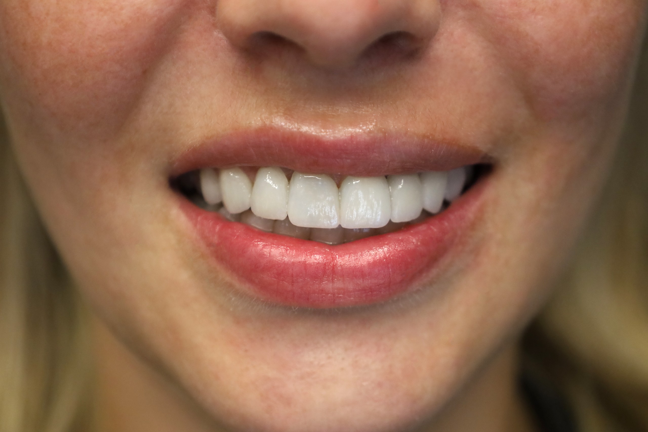 Facettes Emax — WestDent Clinic