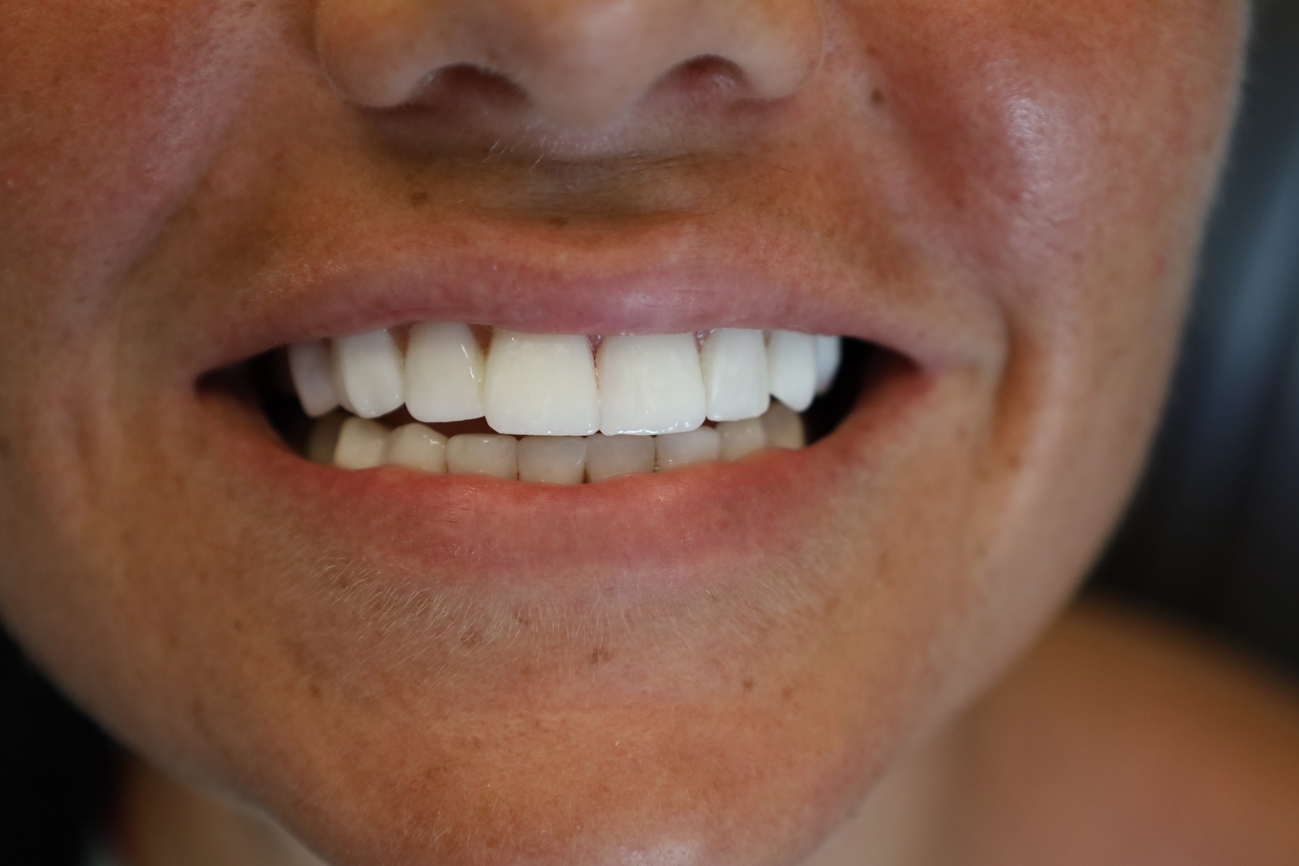 Facettes Emax — WestDent Clinic