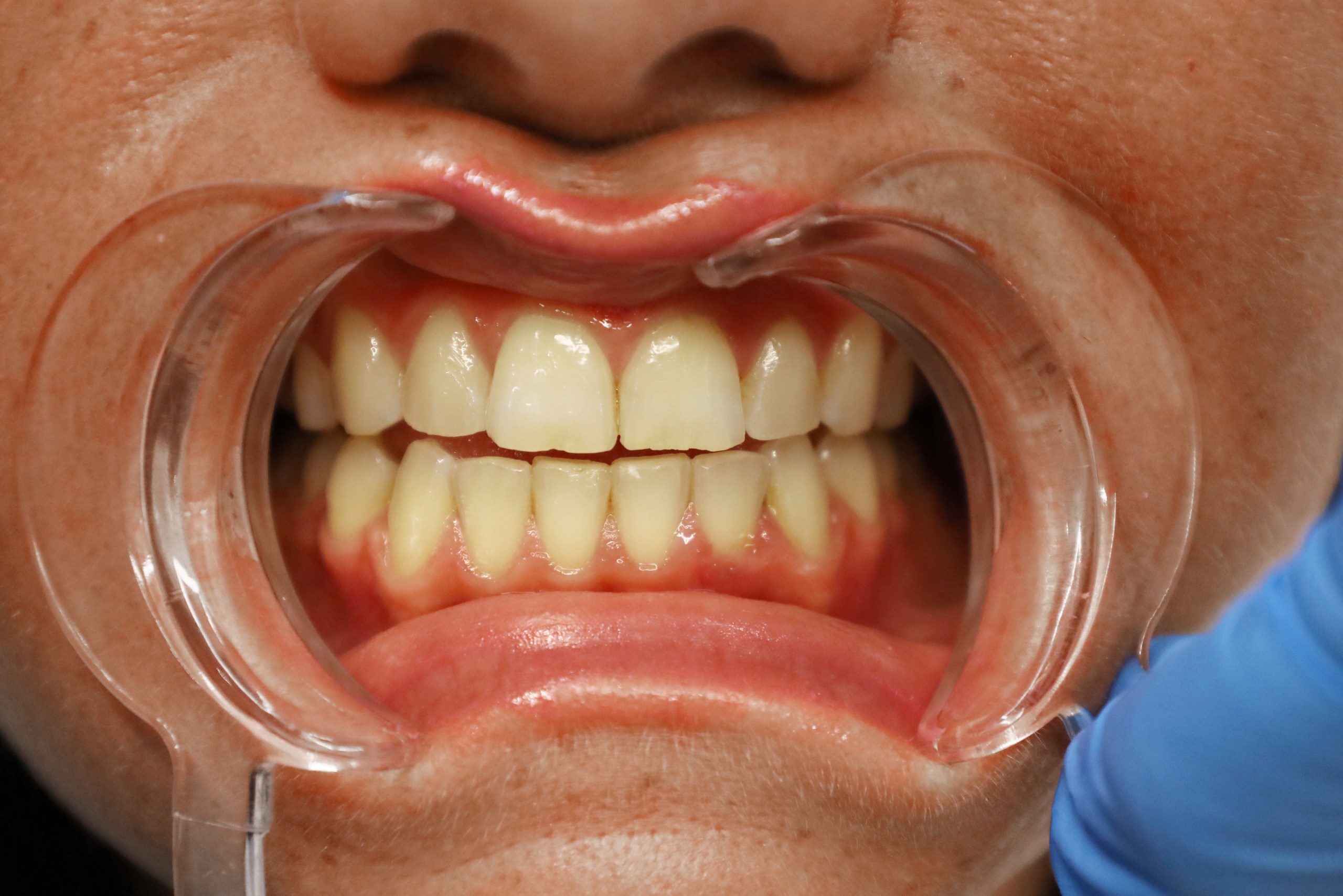 Facettes Emax — WestDent Clinic