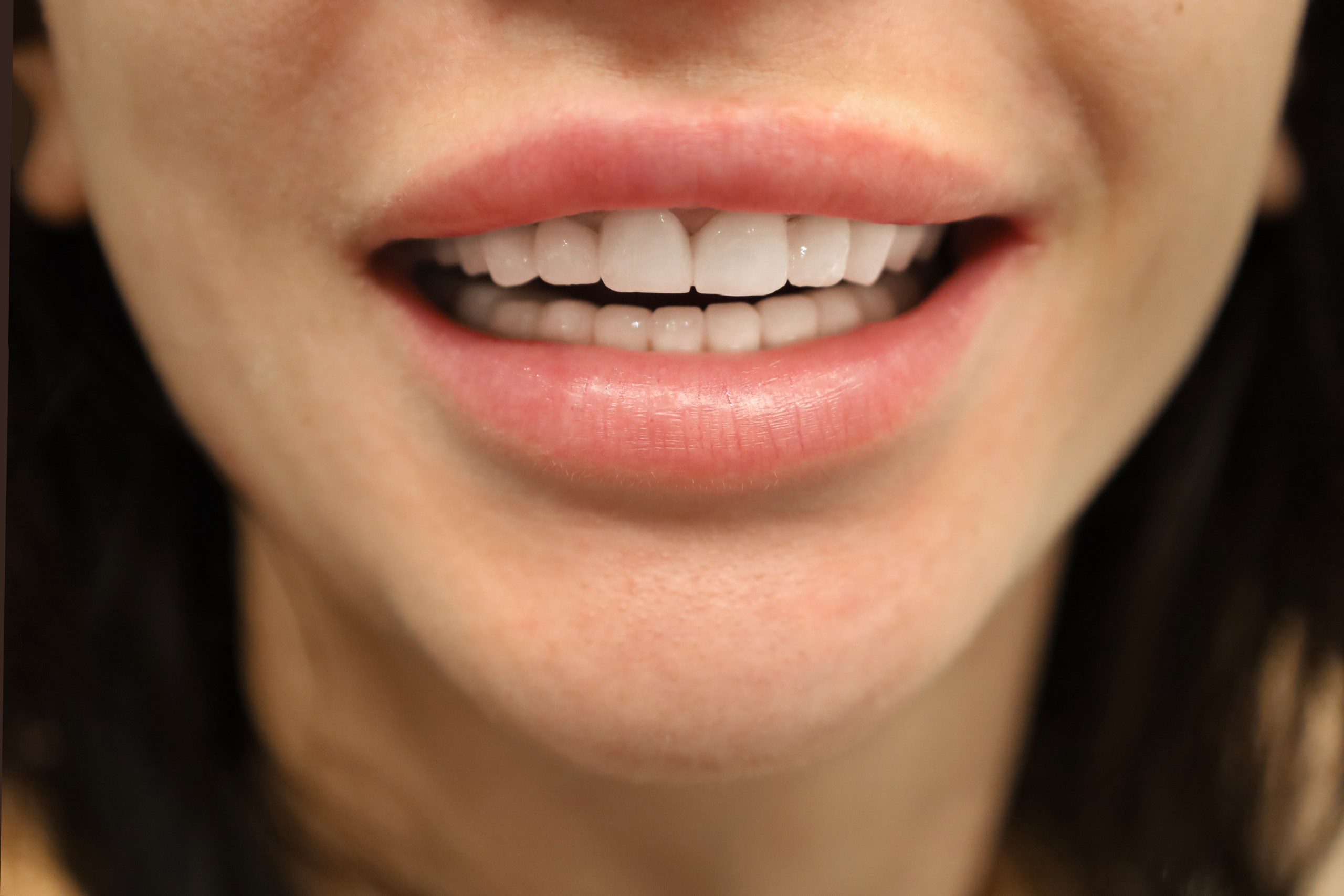 Facettes Emax — WestDent Clinic