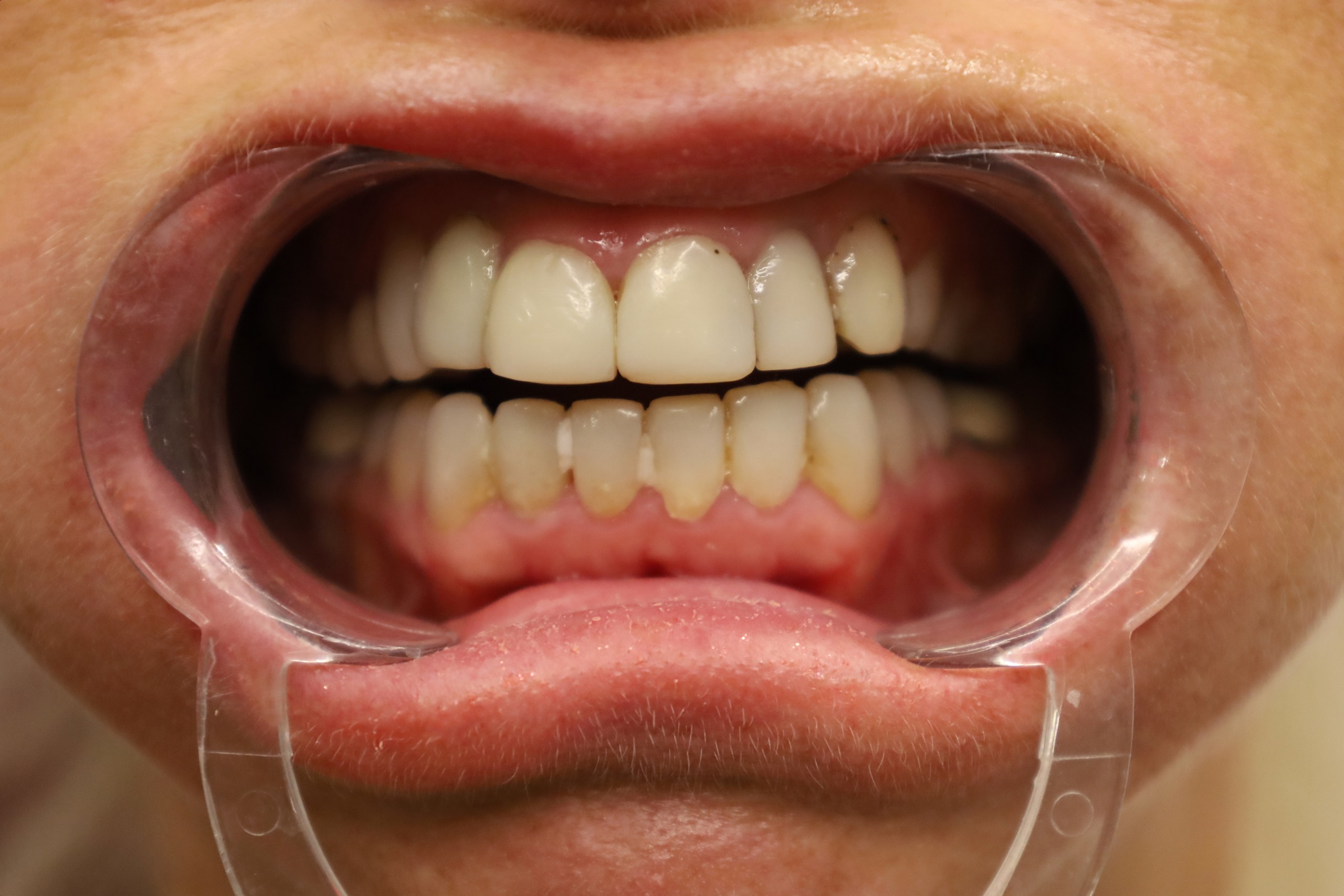 Facettes Emax — WestDent Clinic