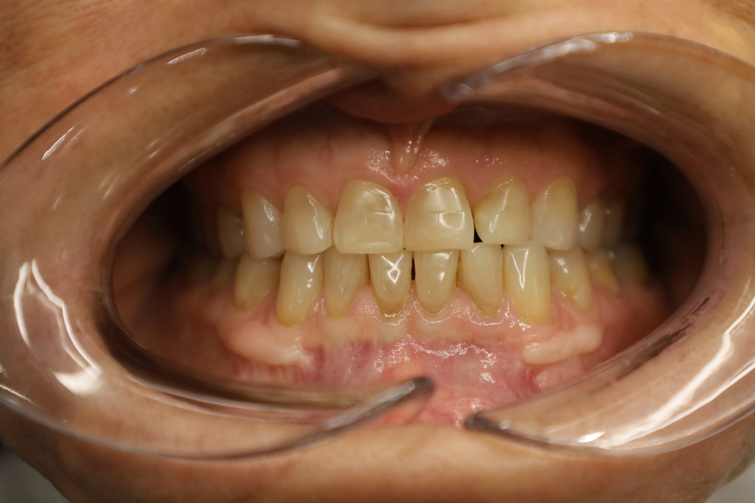 Facettes Emax — WestDent Clinic
