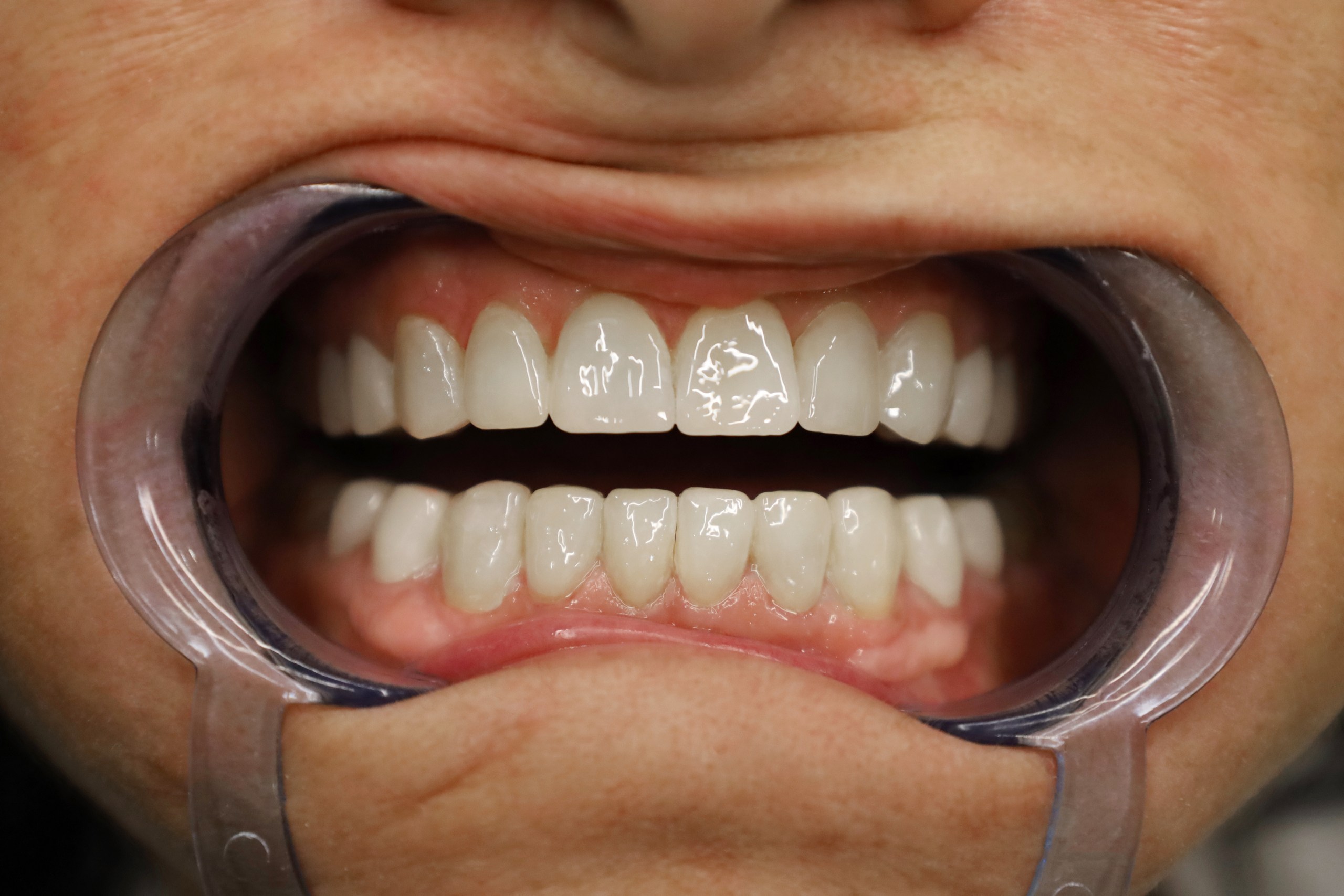 Facettes Emax — WestDent Clinic
