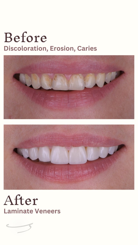 Differences between Veneers and Lumineers dental veneers - Estetica Dentale  a Roma