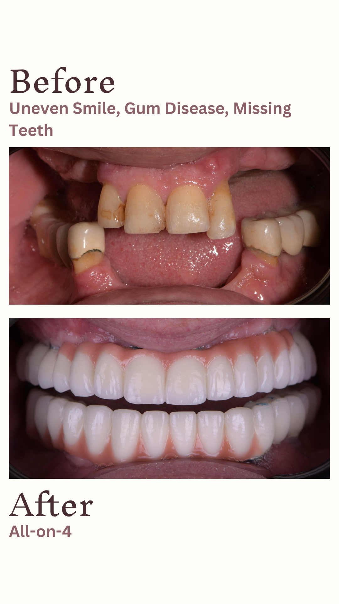 Implants Straumann — Ultimadent