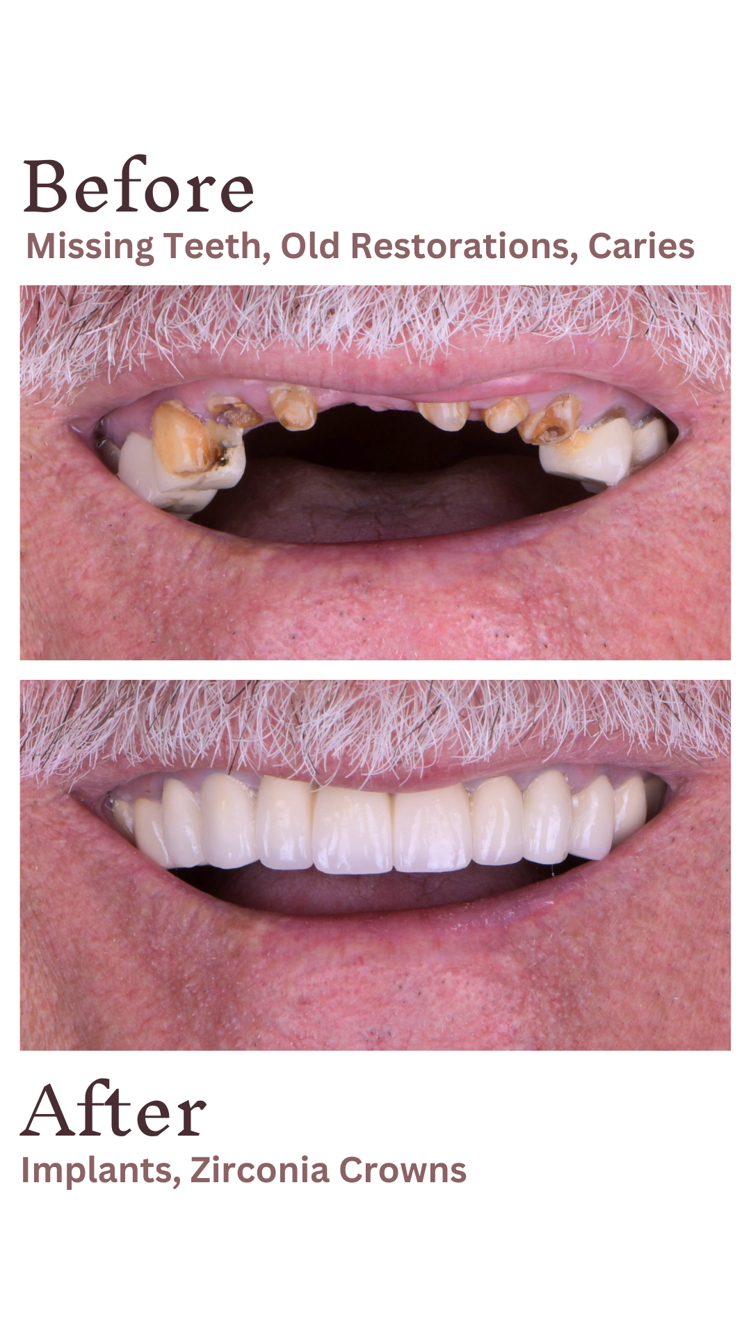 Implants Straumann — Ultimadent
