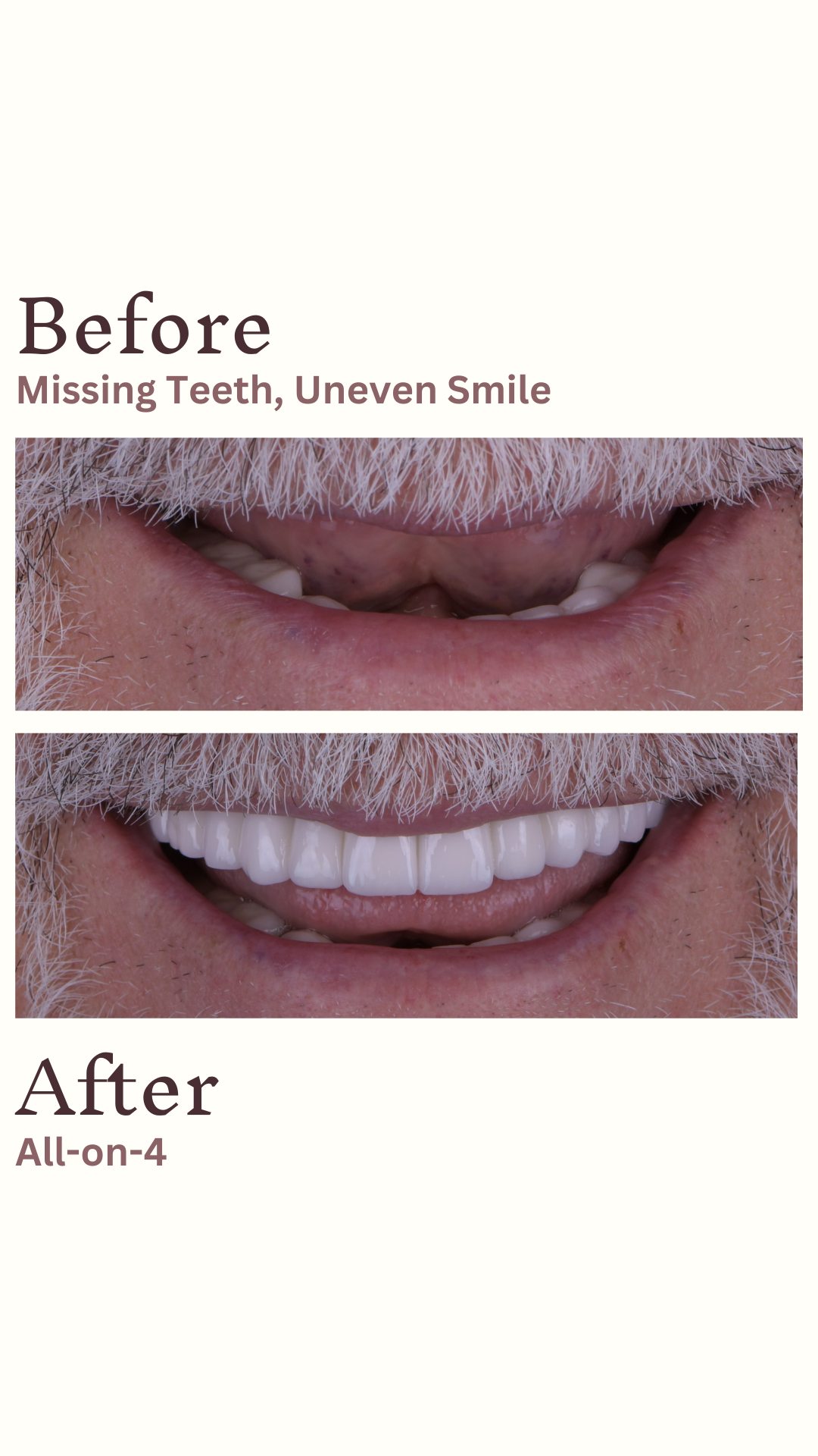 Implants Straumann — Ultimadent