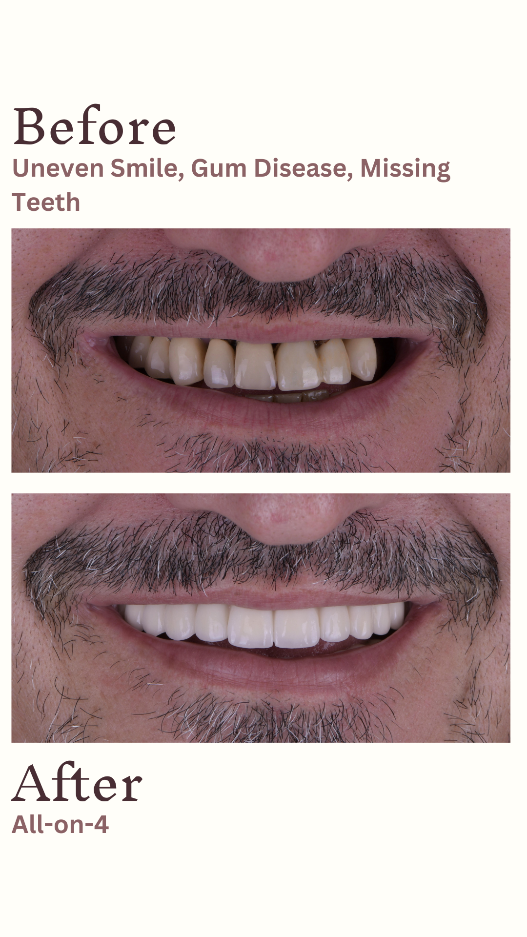 Implants Straumann — Ultimadent