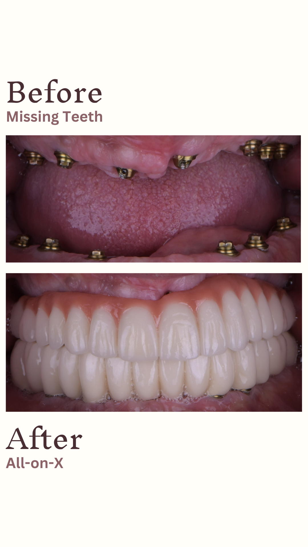 Implants Straumann — Ultimadent