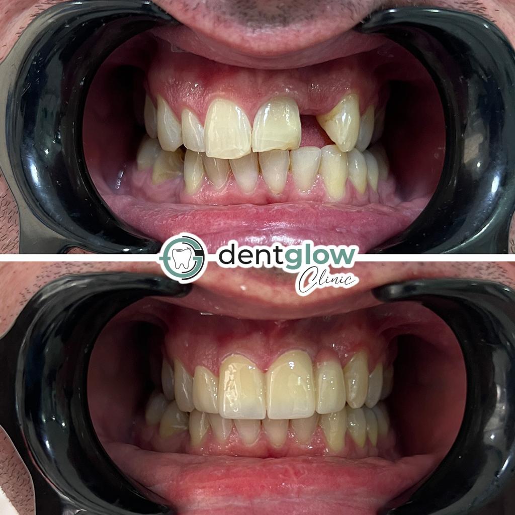 Facettes Pelliculaires — Dentglow