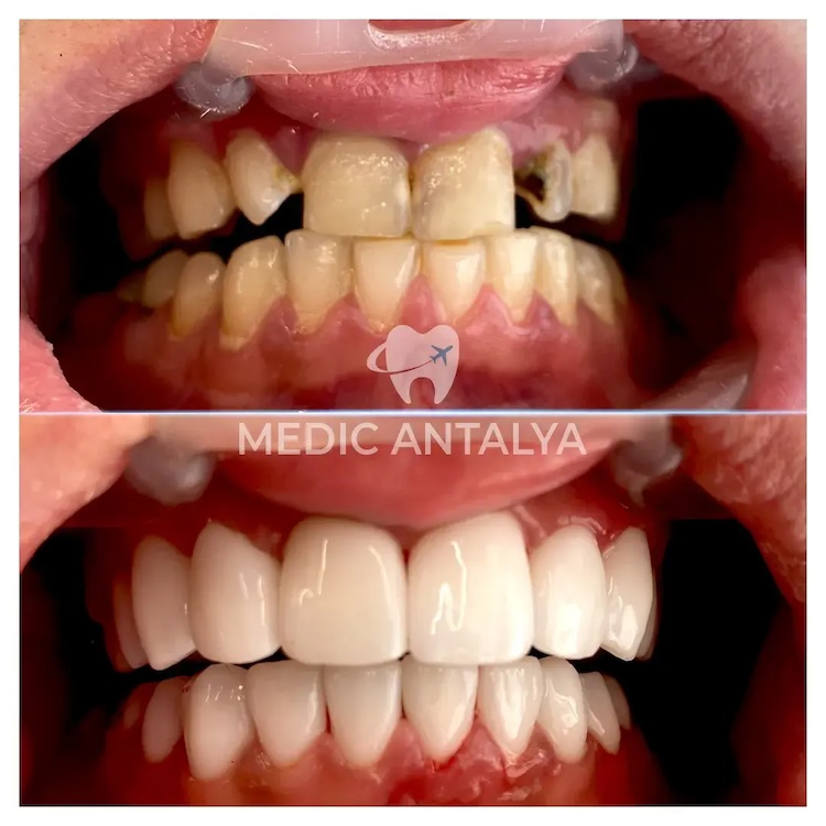 Corone dentali — Medic Antalya