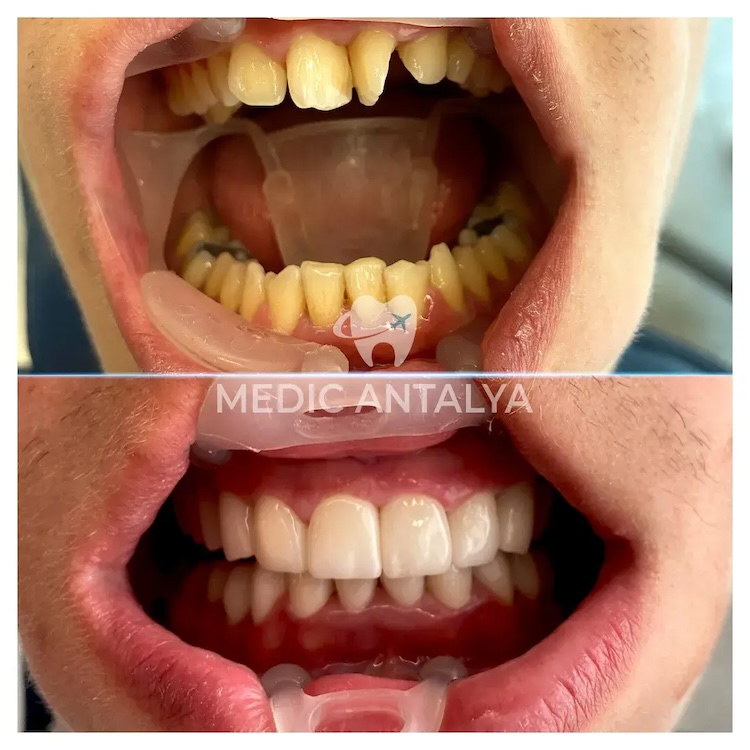 Corone dentali — Medic Antalya