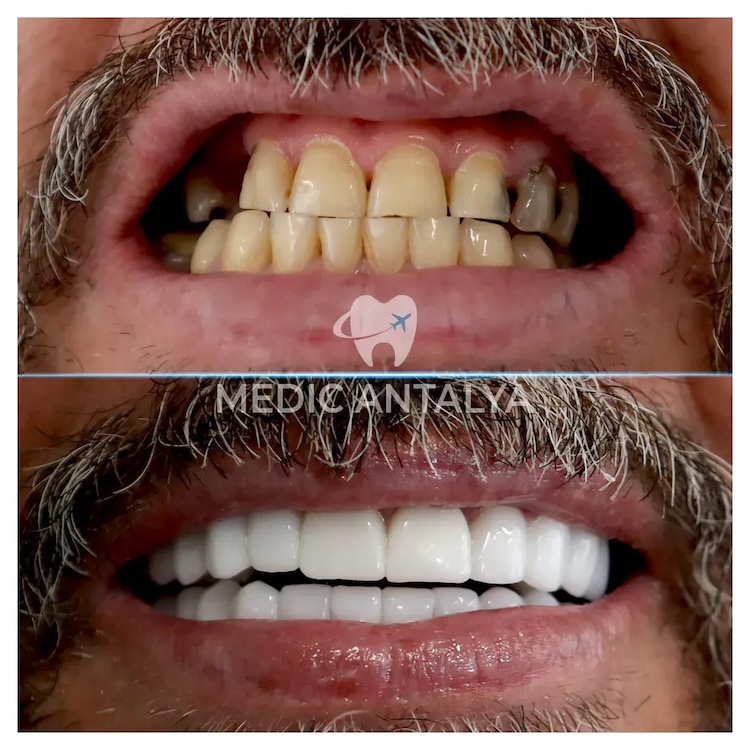 Corone dentali — Medic Antalya
