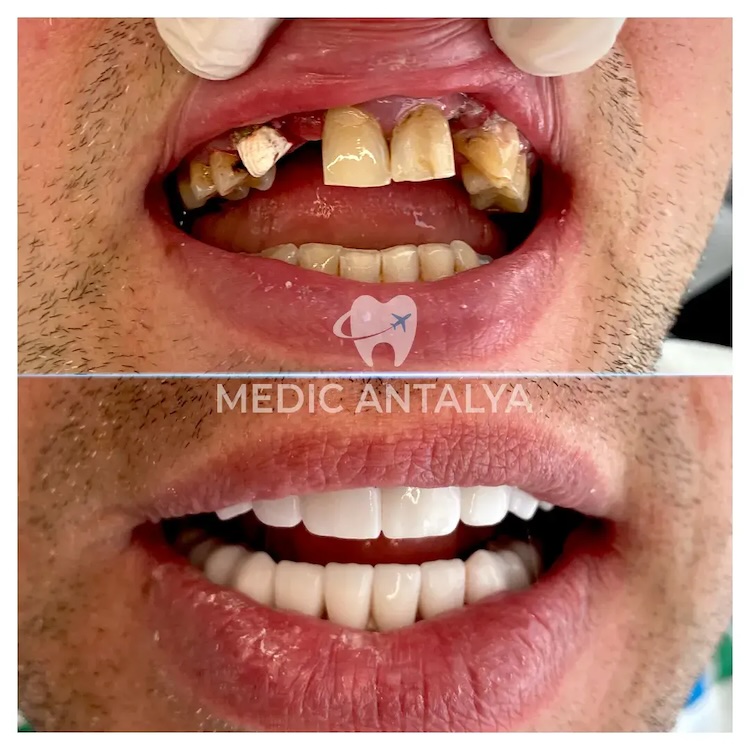 Corone dentali — Medic Antalya