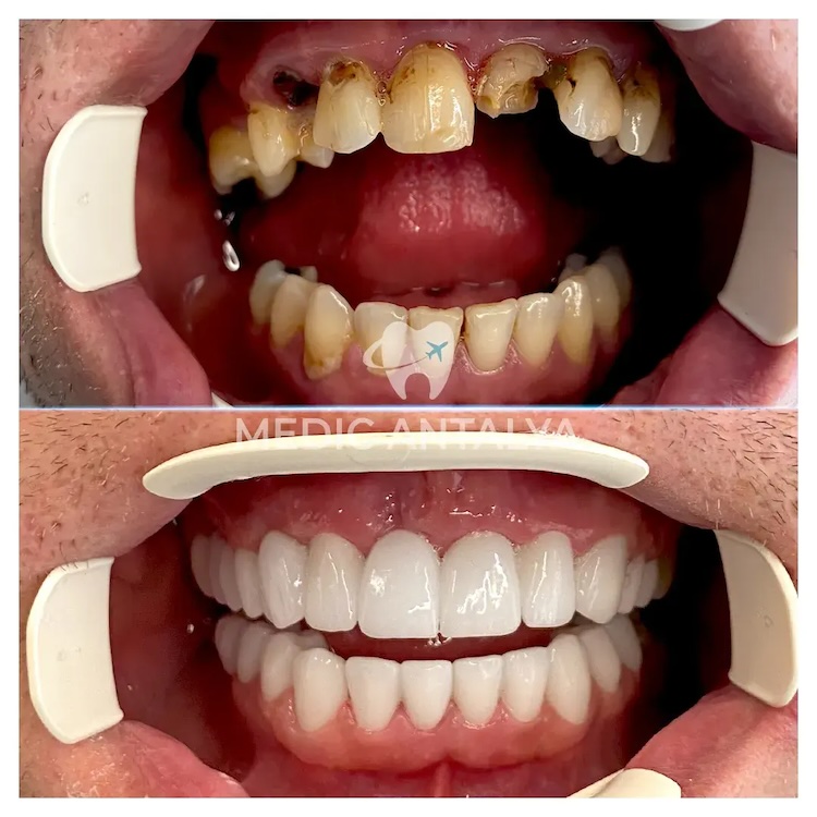 Corone dentali — Medic Antalya