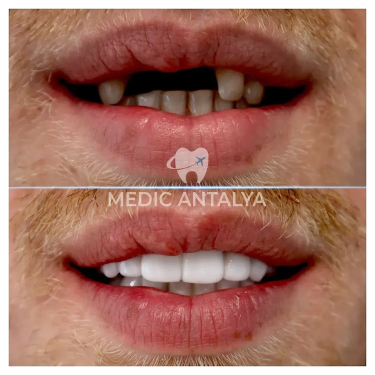 Corone dentali — Medic Antalya
