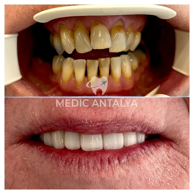 Corone dentali — Medic Antalya