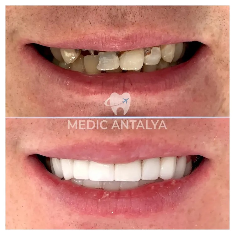 Corone dentali — Medic Antalya