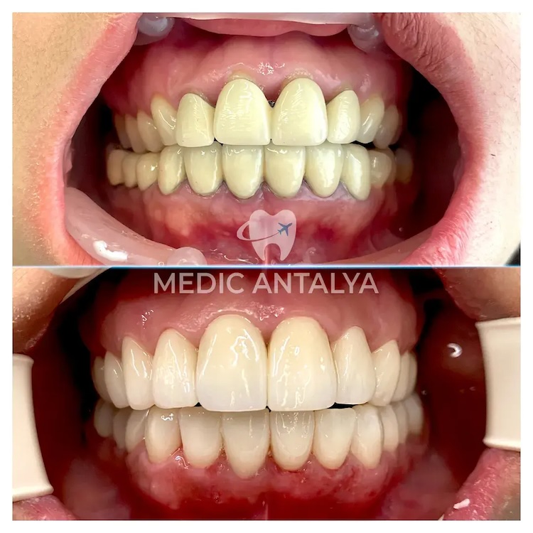 Corone dentali — Medic Antalya