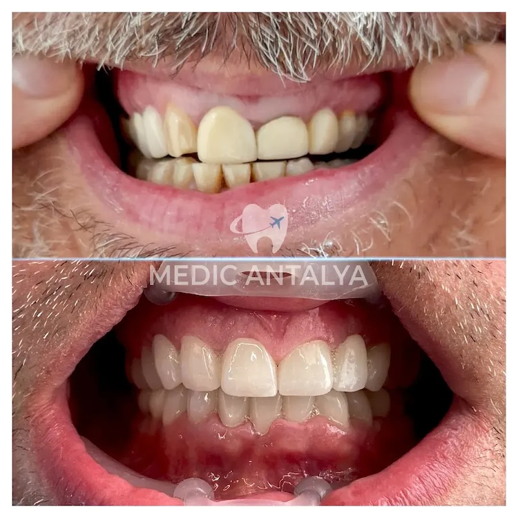 Corone dentali — Medic Antalya