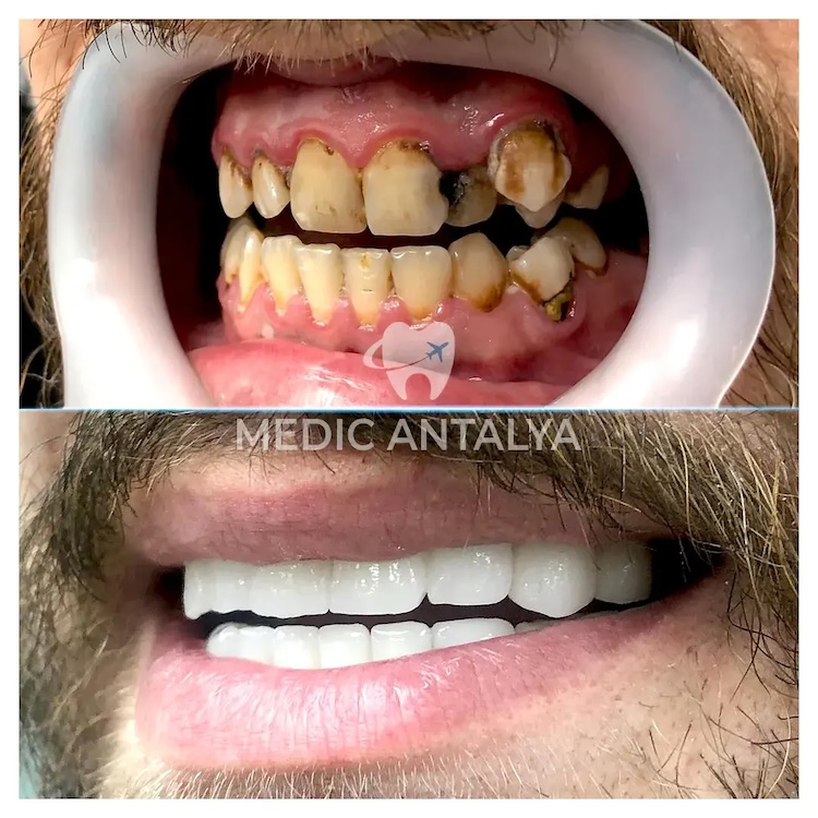 Corone dentali — Medic Antalya