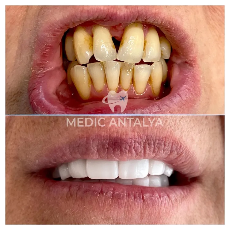 Corone dentali — Medic Antalya