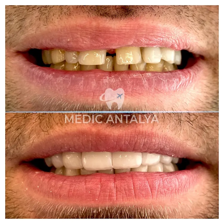 Facettes Dentaires — Medic Antalya