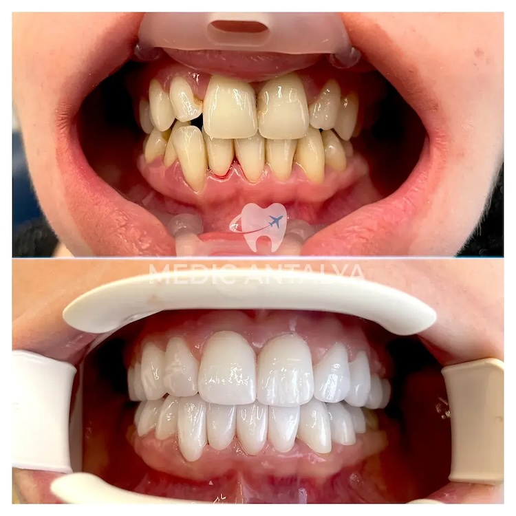 Facettes Dentaires — Medic Antalya