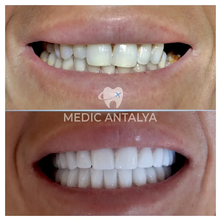 Facettes Dentaires — Medic Antalya