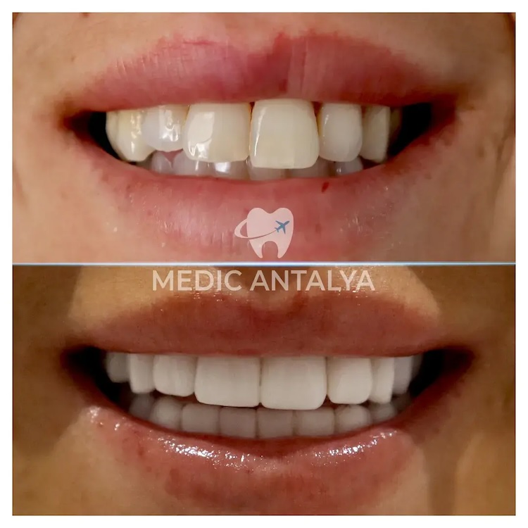 Facettes Dentaires — Medic Antalya