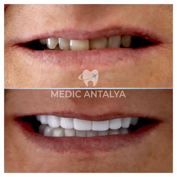 Facettes Dentaires — Medic Antalya