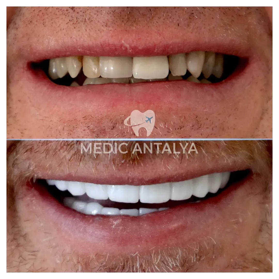 Facettes Dentaires — Medic Antalya