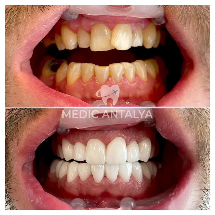 Facettes Dentaires — Medic Antalya