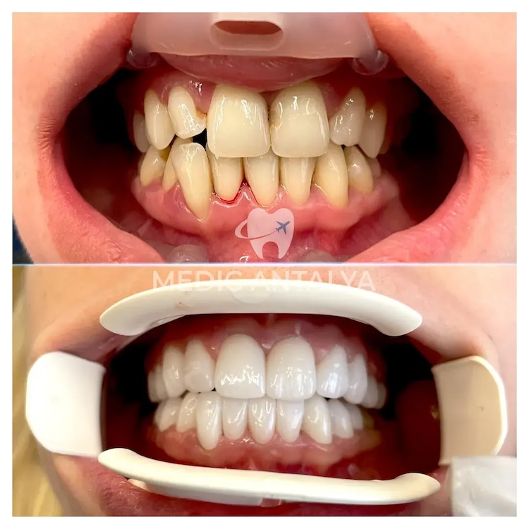 Facettes Dentaires — Medic Antalya