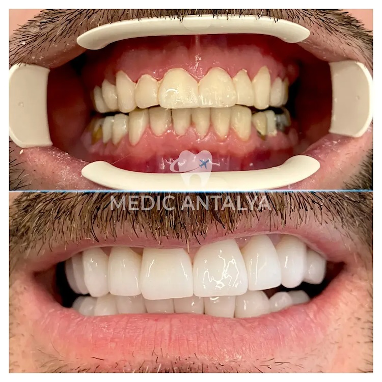 Facettes Dentaires — Medic Antalya