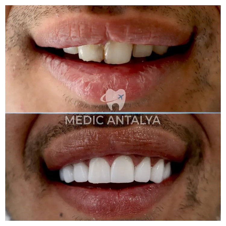 Facettes Dentaires — Medic Antalya
