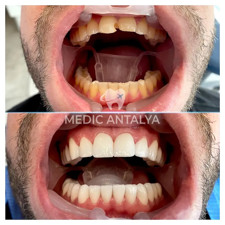 Facettes Dentaires — Medic Antalya
