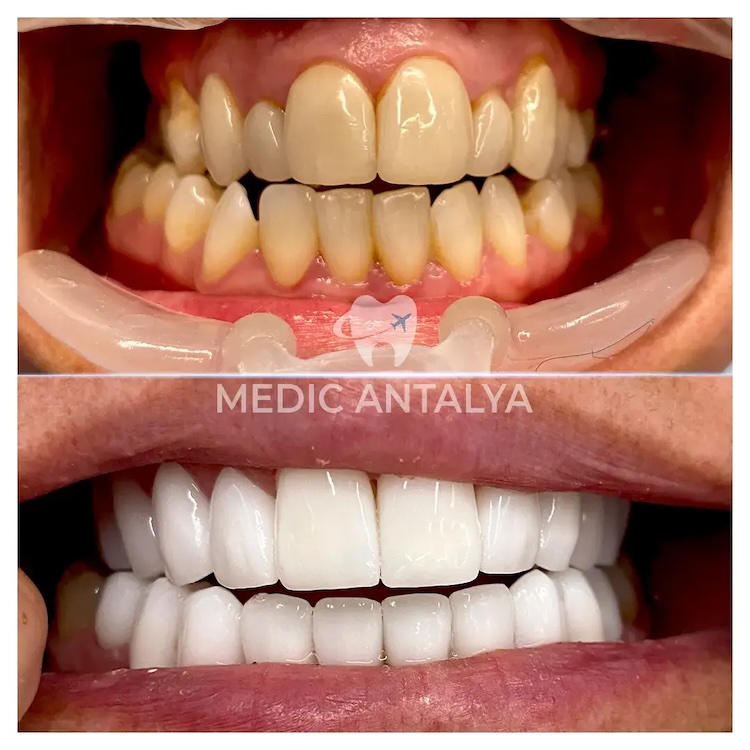 Facettes Dentaires — Medic Antalya