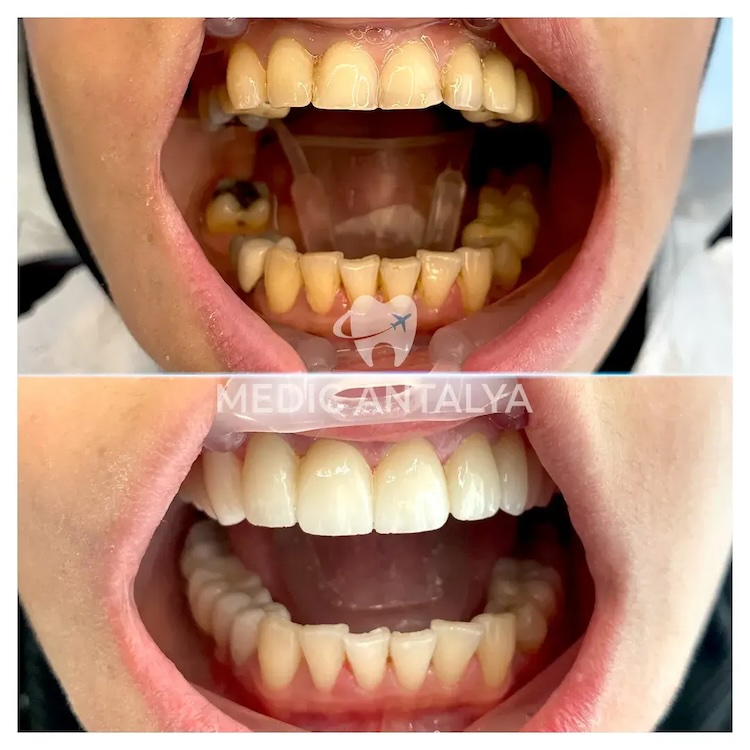 Facettes Dentaires — Medic Antalya