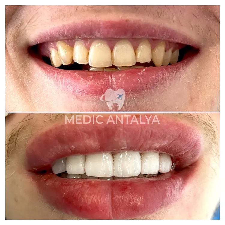 Facettes Dentaires — Medic Antalya