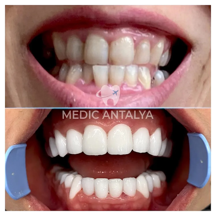 Facettes Dentaires — Medic Antalya