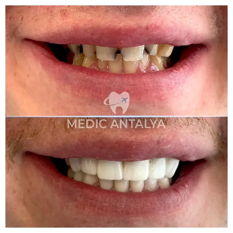 Facettes Dentaires — Medic Antalya