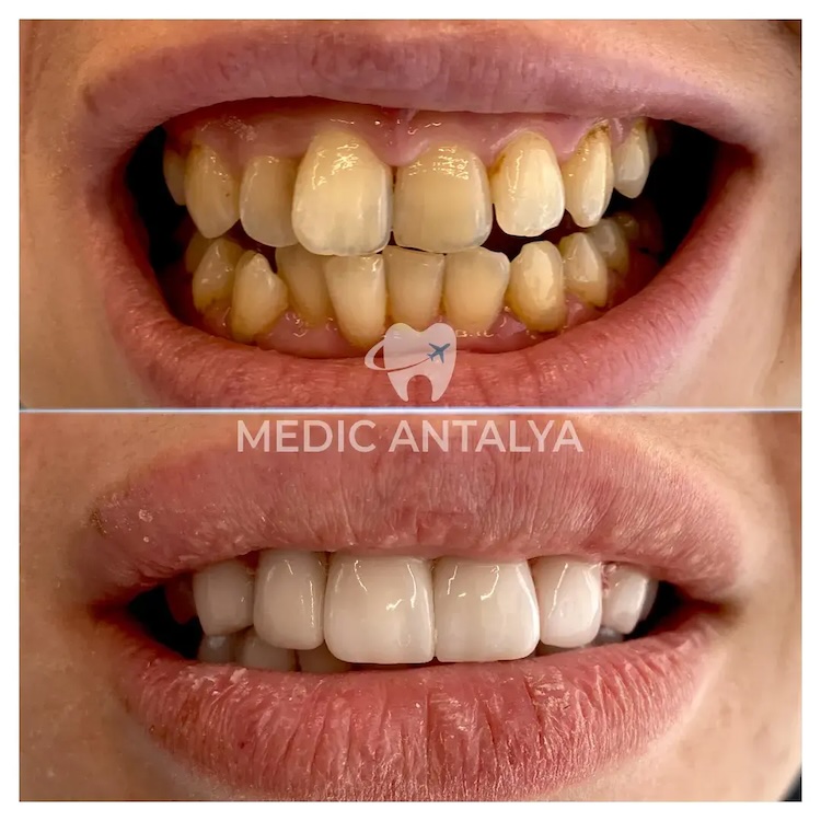 Facettes Dentaires — Medic Antalya