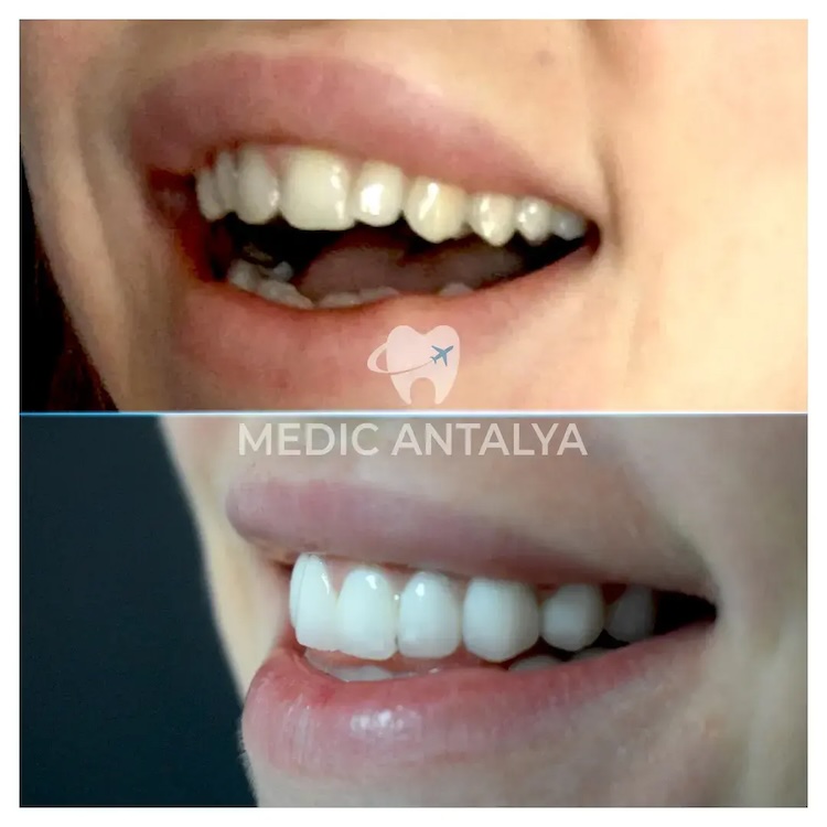 Facettes Dentaires — Medic Antalya