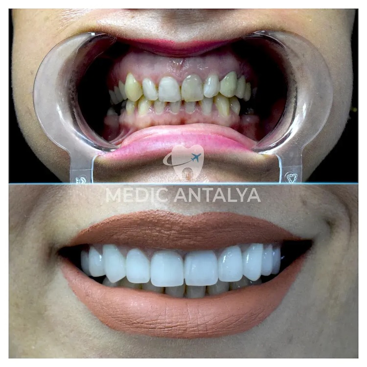 Facettes Dentaires — Medic Antalya